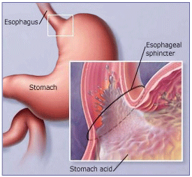 symptoms of gastric reflux