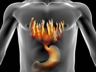 what are the signs of acidity and heartburn