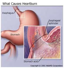 heartburn causes